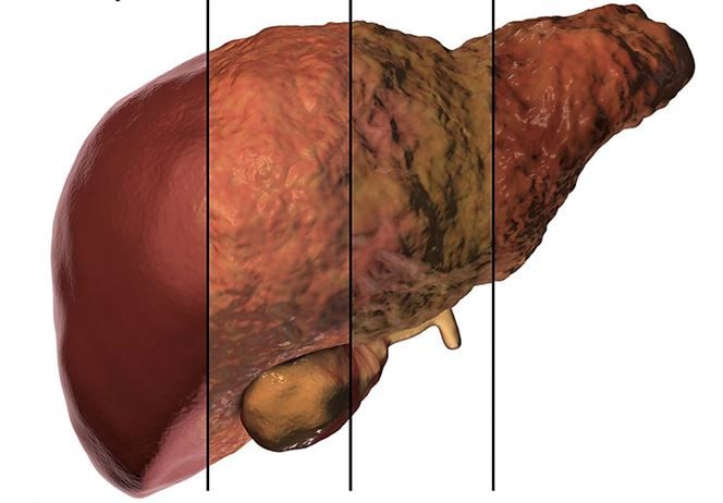 In Sufferers with NAFLD, Kind 2 Diabetes Considerably Ups Threat for Hepatic Decompensation, Hepatocellular Carcinoma